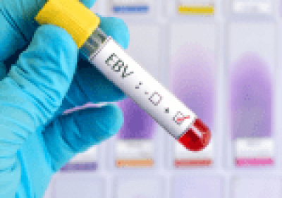 Epstein Barr Virus link with mystery chronic illness