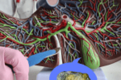 Liver Cleanse to Avoid Gallstone Pancreatitis - gallstone