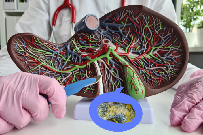 Liver Cleanse to Avoid Gallstone Pancreatitis - gallstone
