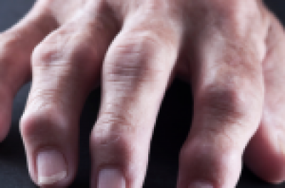 Rheumatoid Arthritis Natural Cure